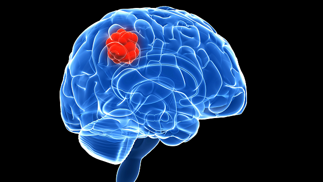 Image result for brain cancer
