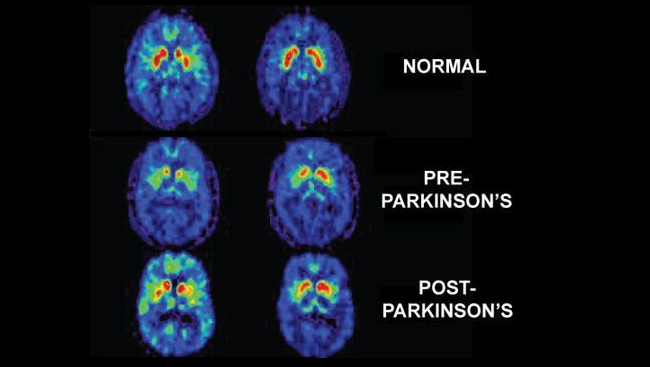 Unlocking Parkinson's Disease
