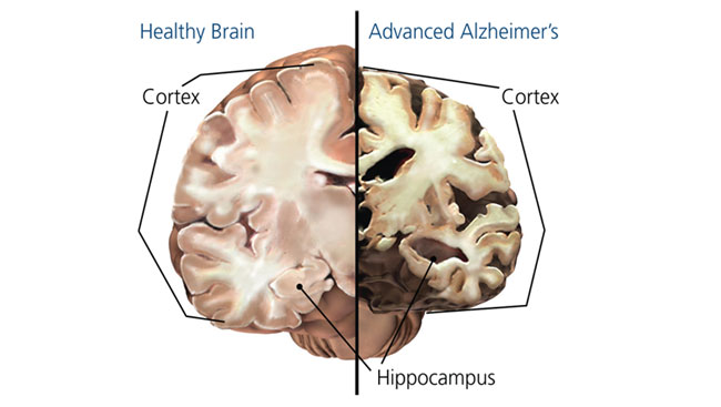 Alzheimer's Disease and Dementia Today