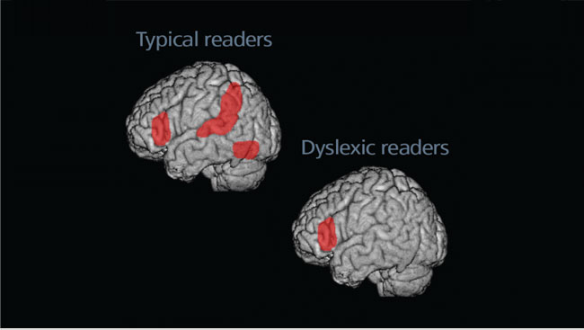 Dyslexia and the Brain Today
