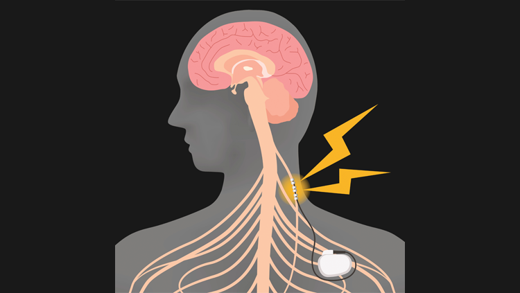 Are Commercial Vagus Nerve Stimulation Devices Safe and Effective?