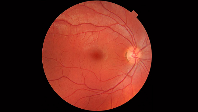 Macular Degeneration: Searching for a Treatment