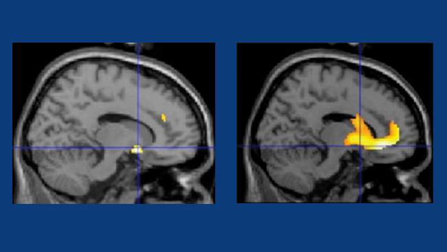 Brain scan showing the active areas when viewing images of food