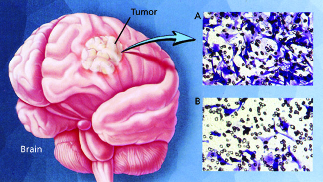 A close up of brain tumor cells.