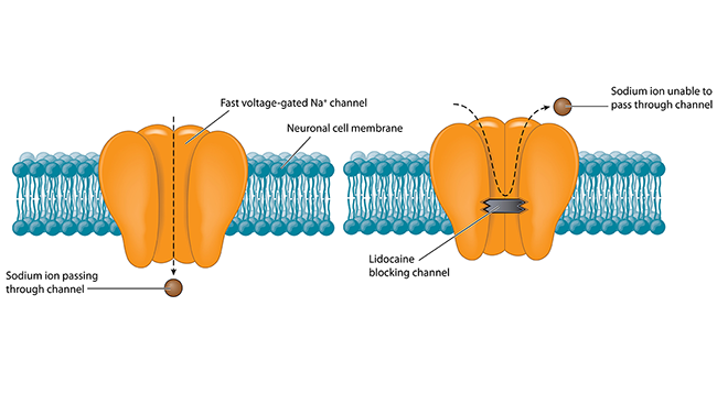 The flux of charged atoms in and out of neurons drives electrical signaling. Sodium ions pass through tiny pores in the cell membrane called sodium channels. Anesthetic drugs like lidocaine squelch pain signals at the source by blocking these channels. 