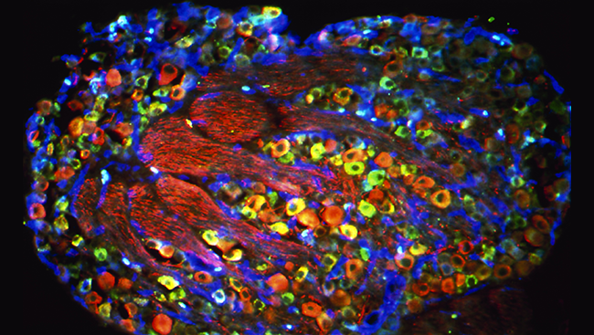 Located throughout the body, pain-sensing neurons transmit pain signals to the spinal cord. Their cell bodies — and the cell bodies of other sensory neurons — cluster in structures alongside the spinal cord called dorsal root ganglia. This cross section of one dorsal root ganglion shows the cell bodies of touch-sensing neurons (red) and pain-sensing neurons (green and blue).