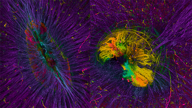 This image shows the retinas of two embryonic mice. The retina on the left is healthy; the axons (purple) are all arranged on the same plane and growing toward the center. The retina on the right, however, has axons (red and yellow) that are extending in abnormal directions, invading other parts of the eye.