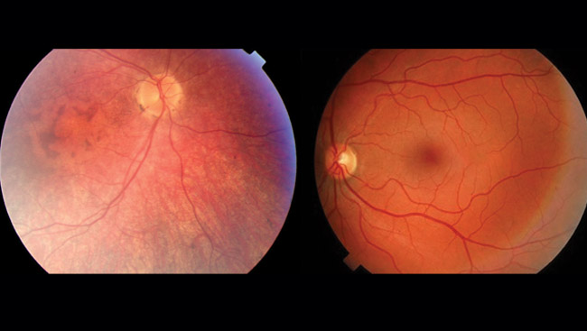 Contrast of normal retinas and ones with LCA