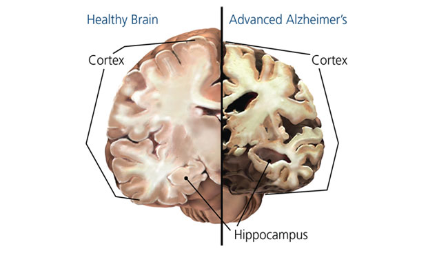 Image of a brain with Alzhimer's disease