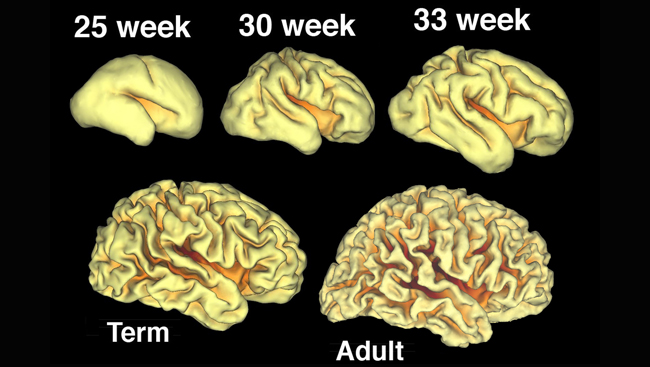 Images of brains in five states of development: 25 weeks, 30 weeks, 33 weeks, full term, and adult.