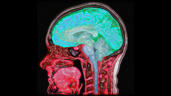 MRI of the human head