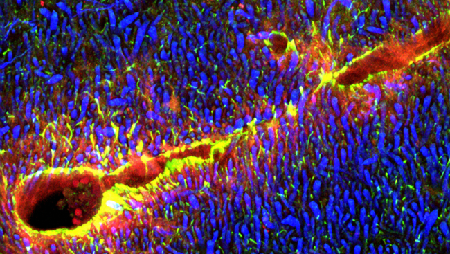 Some brain cancers and infections cause the blood-brain barrier to break down. When this happens, substances that are typically kept out gain entry to the brain. This image from the brainstem shows a blood vessel with a compromised blood-brain barrier.