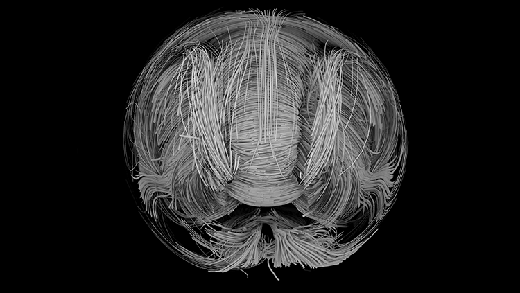 Diffusion magnentic resonance image (DMI) of the brain