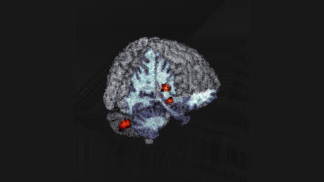 Three-dimensional model of the brain showing regions of increased volume in the insula, cerebellar vermis, and substantia nigra in individuals with genetic predisposition for bipolar disorder. 