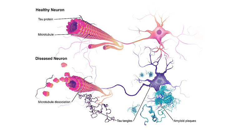 Alzheimer's Disease