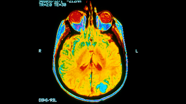 Image of an MRI scan of a cancerous tumor in a brain