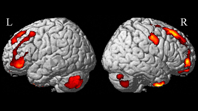 MRI scan shows decreases in gray matter after one month of chemotherapy, courtesy of Indiana University