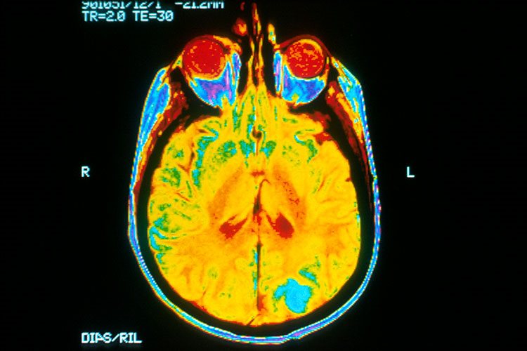 Brain scan