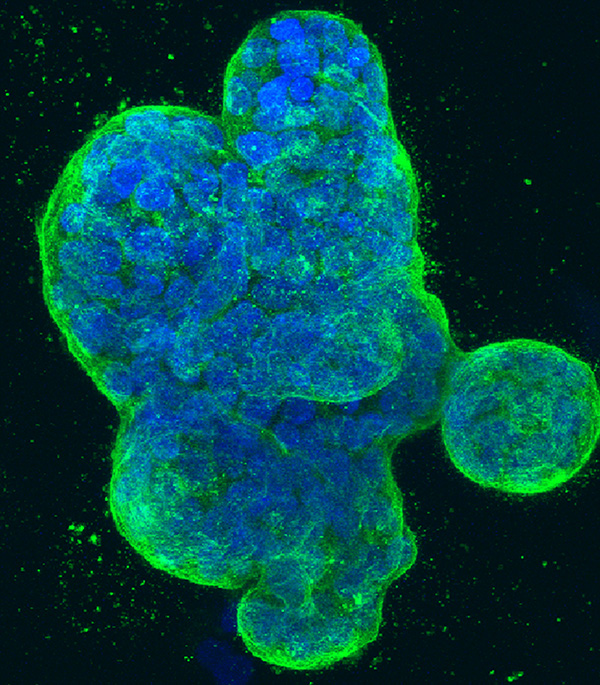 Breast cancer cells in a dish