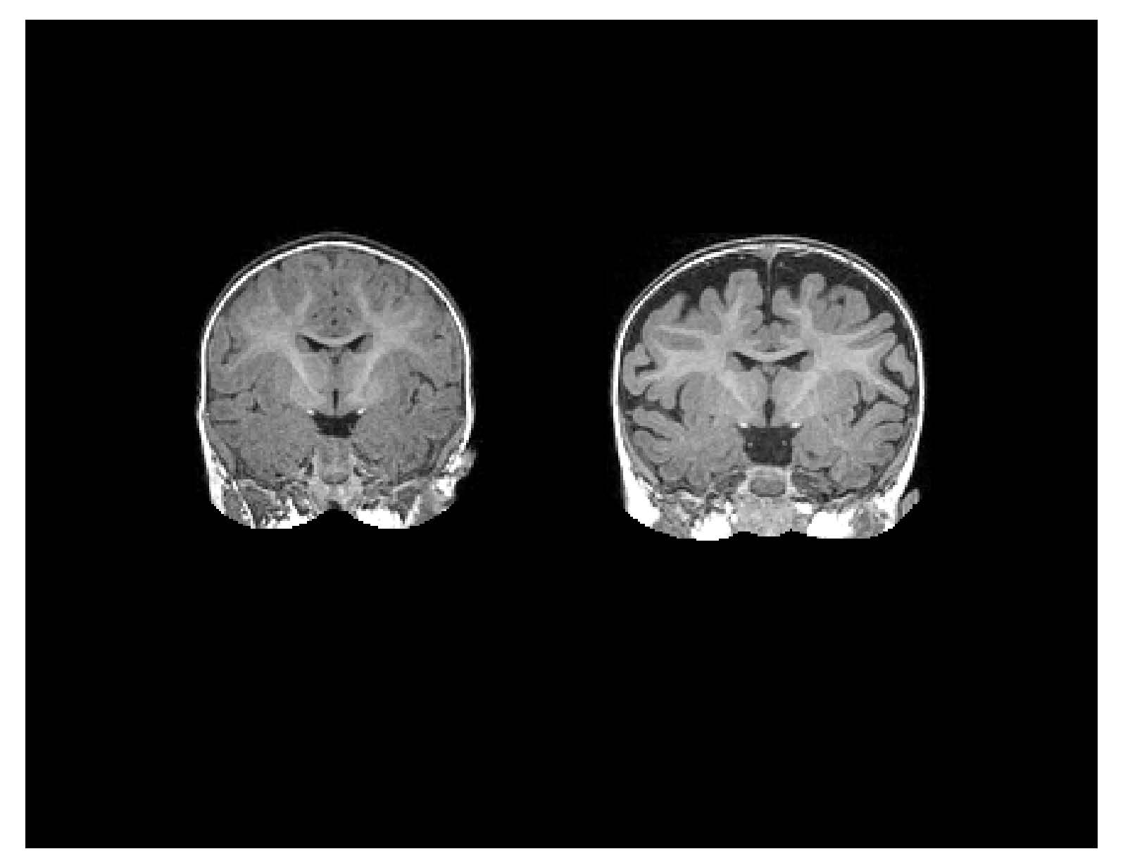 Image of brain scan of infant with autism and infant without