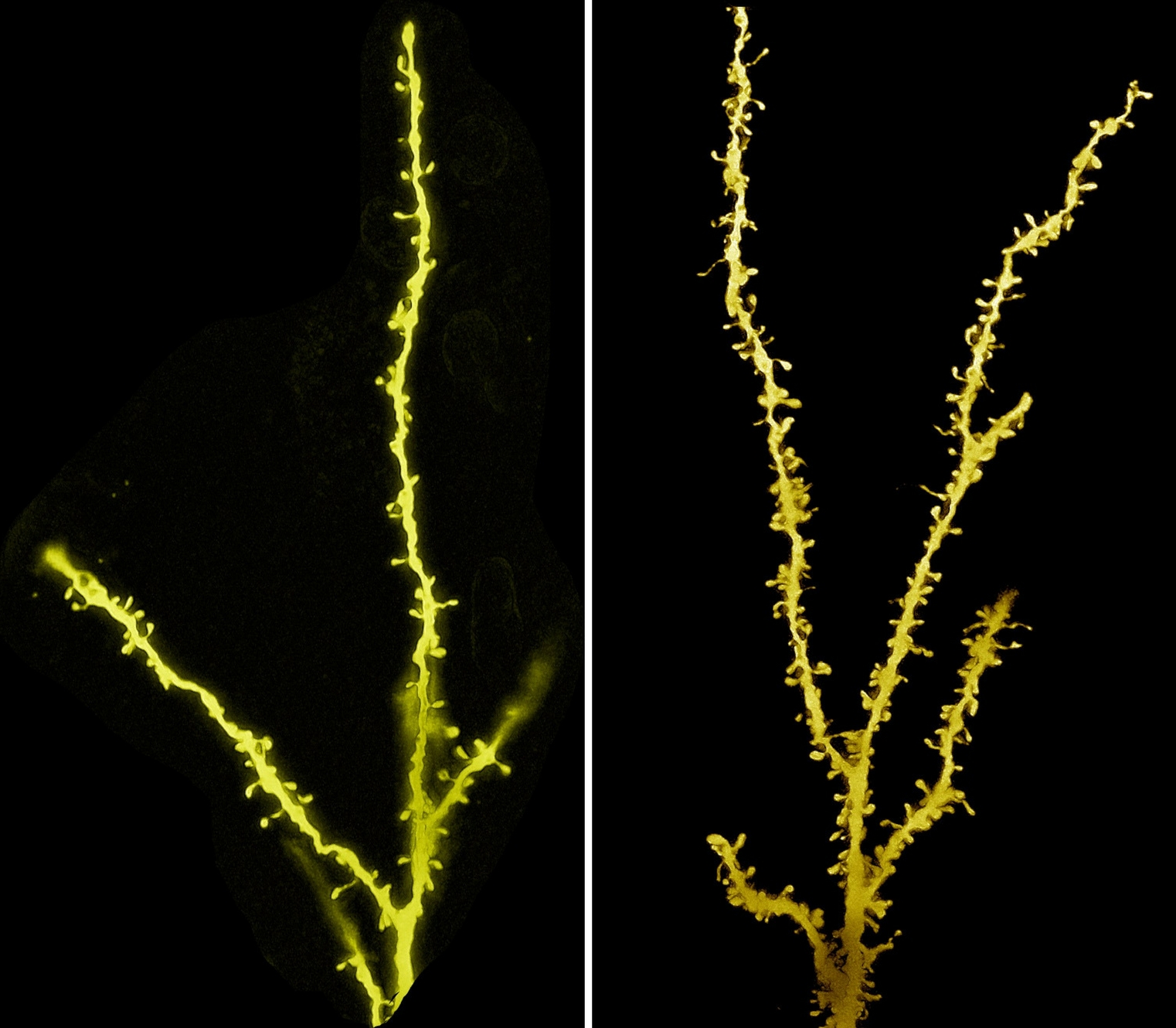 Image of dendrite spines in child with autism and in child without