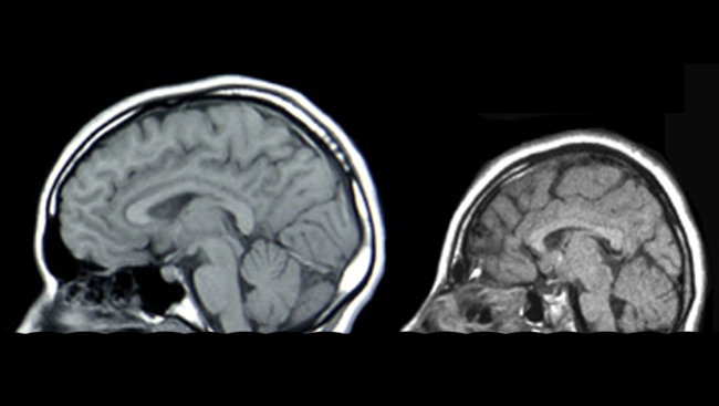 Scans of a brain with microcephaly (right) and a normal sized brain. 