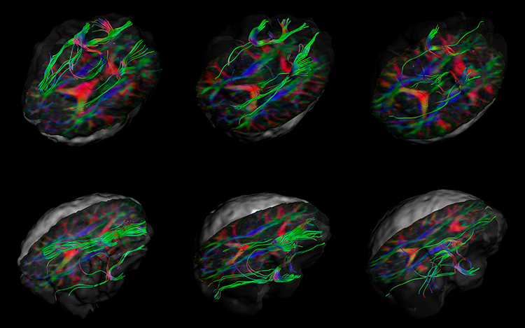 Image of white matter fibres of the uncinate fasciculus