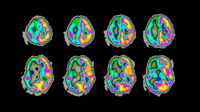 This image shows the abnormally high activity of the right part of the brain during an epileptic seizure. 