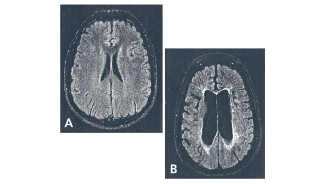 Brain tissue loss scan