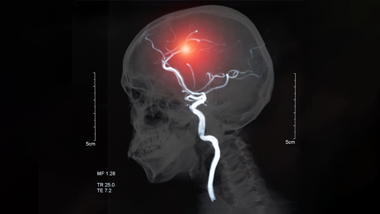 Image of stroke in a brain