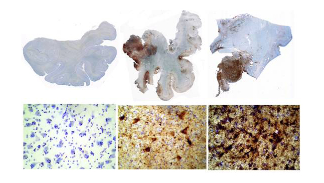 Brain tissue from a healthy individual, an NFL football player, and a boxer. 