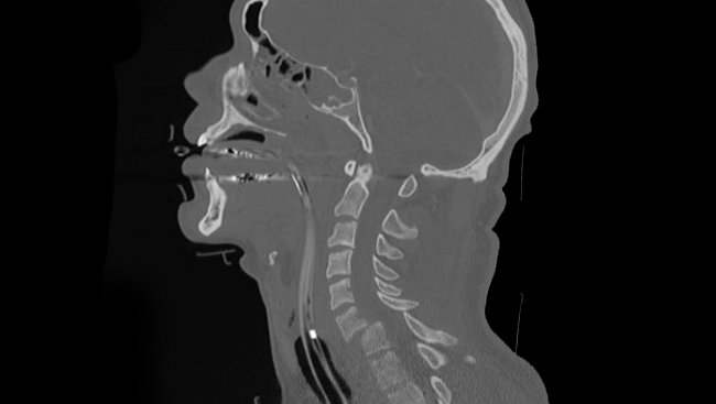 spinal cord injury