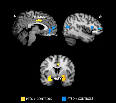 The Changing Face of Post-Traumatic Stress Disorder