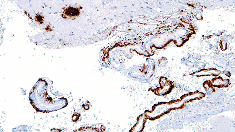 image of amyloid beta