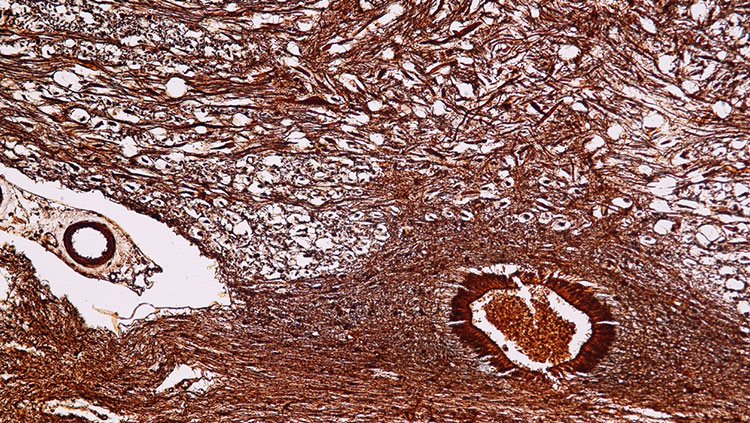 Amyotrophic Lateral Sclerosis