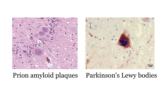 Scan of prion amyloid plaques and Parkinson's Lewy bodies.