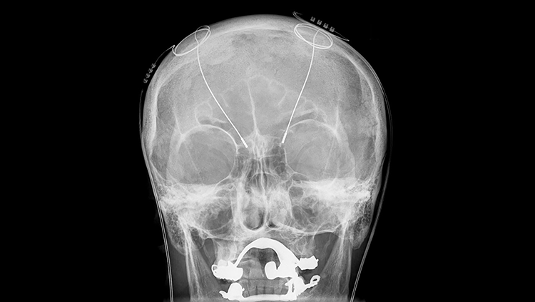 Black-and-white x-ray of a skull with probes
