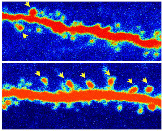 Compared with a control, a rat neuron (in red) treated with ketamine has grown more dendritic spines (shown by yellow arrows).