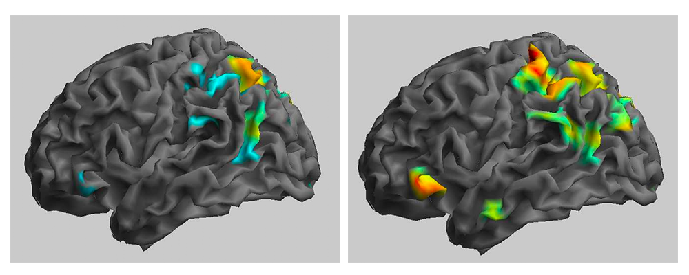 Neural activity prior to a ketamine infusion (on the left) and six to nine hours after an infusion (on the right).