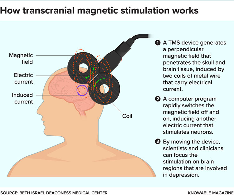 How transcranial magnetic stimulation works graphic