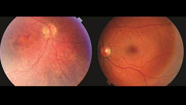 Retinal photographs show how the eyes of a healthy patient and an individual with Leber congenital amaurosis differ.