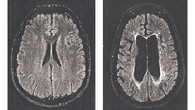 Brain scans show what happens during multiple sclerosis 