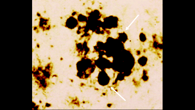 The accumulation of misfolded proteins forming plaques