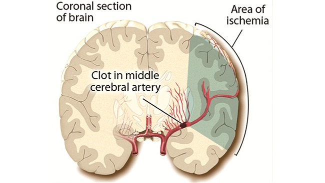 A blood vessel is clogged by a blood clot