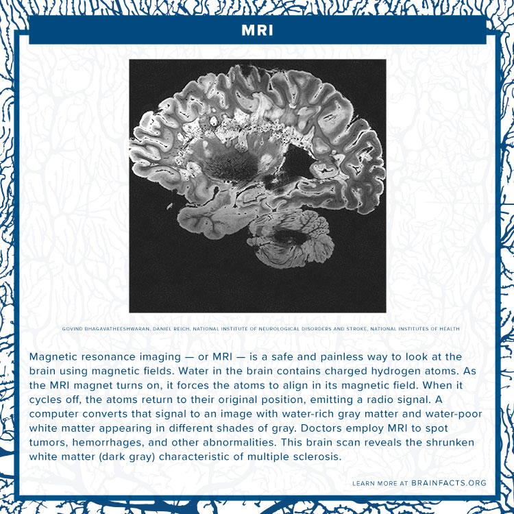 MRI Brain Byte