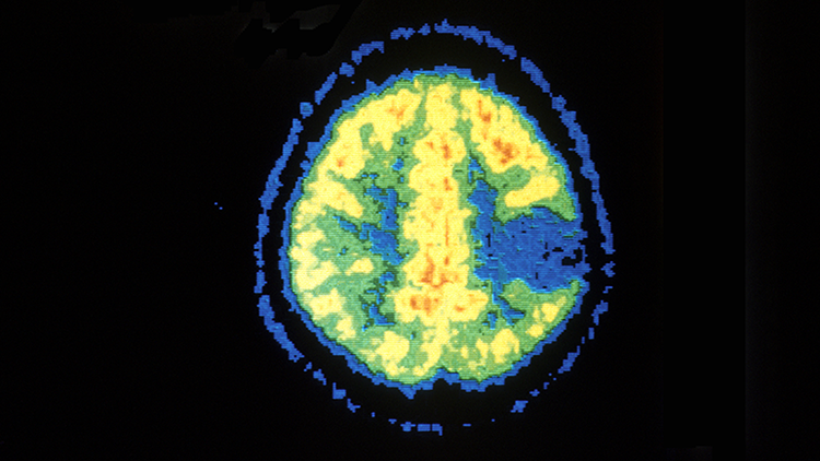 PET scan image