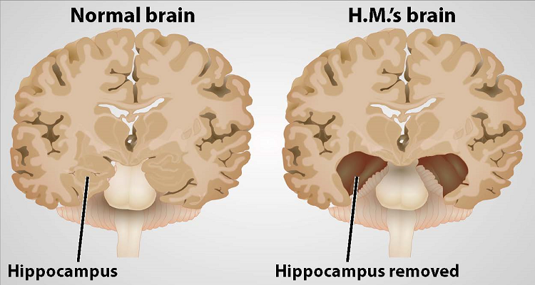 based on the famous case study of h.m a patient