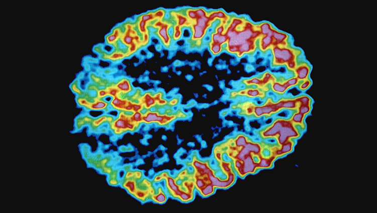 Image of a PET scan in blue and orange