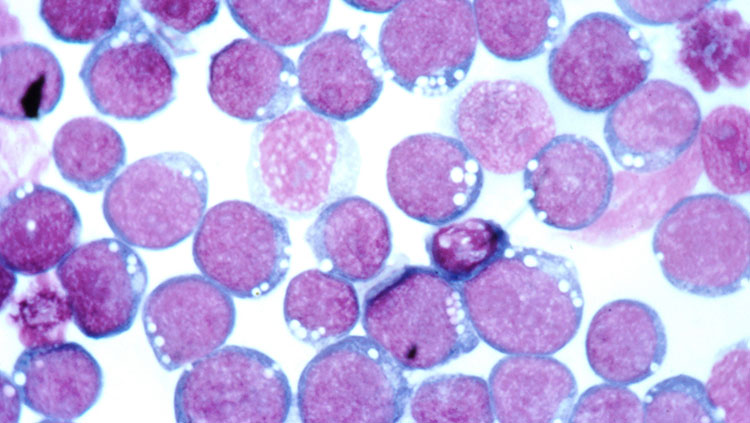 Cells infected with the Epstein-Barr virus.