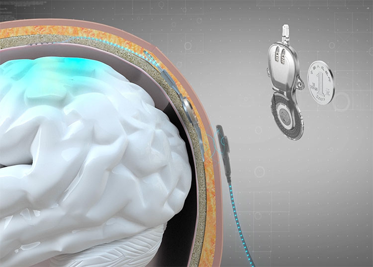 An illustration of the NEO epidural BCI